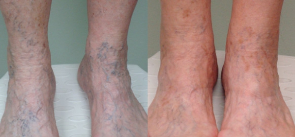 Can Spider Veins Come Back After Treatment? - Dermatologist in San Antonio,  TX